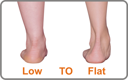 The Planus Foot has a low to flat arch