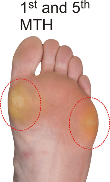 Callus pattern for the A Quad