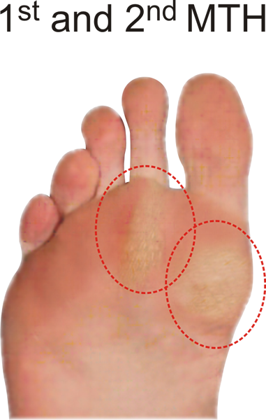 Callus pattern for the B Quad