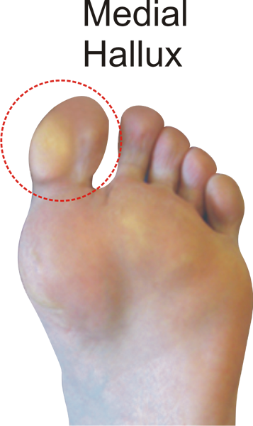 Callus pattern for the C Quad