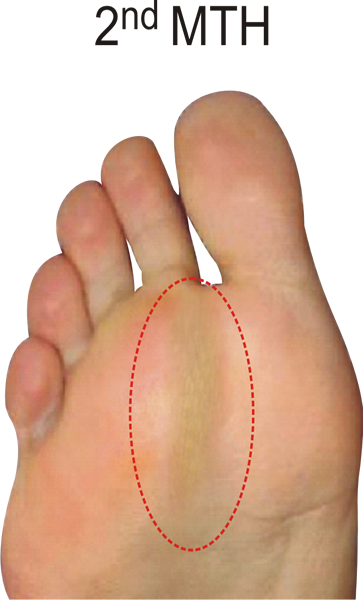 Callus pattern for the D Quad