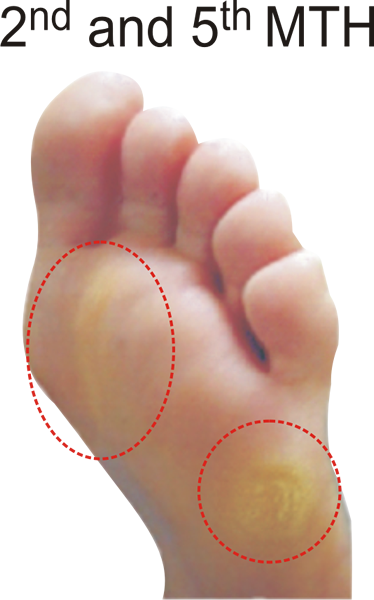 Callus pattern for the E Quad