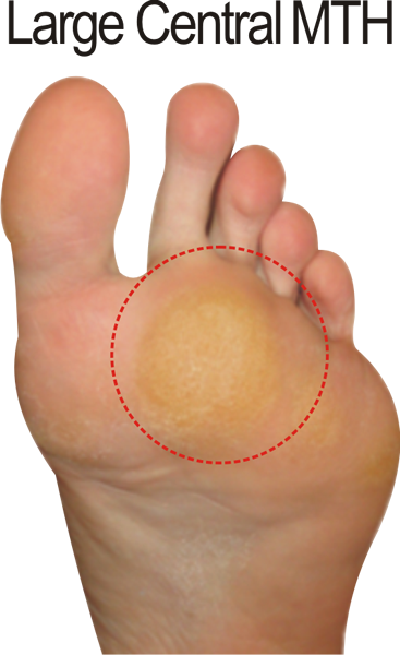 Callus pattern for the F Quad