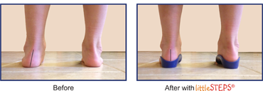 See the Difference littleSTEPS® foot orthotics make!